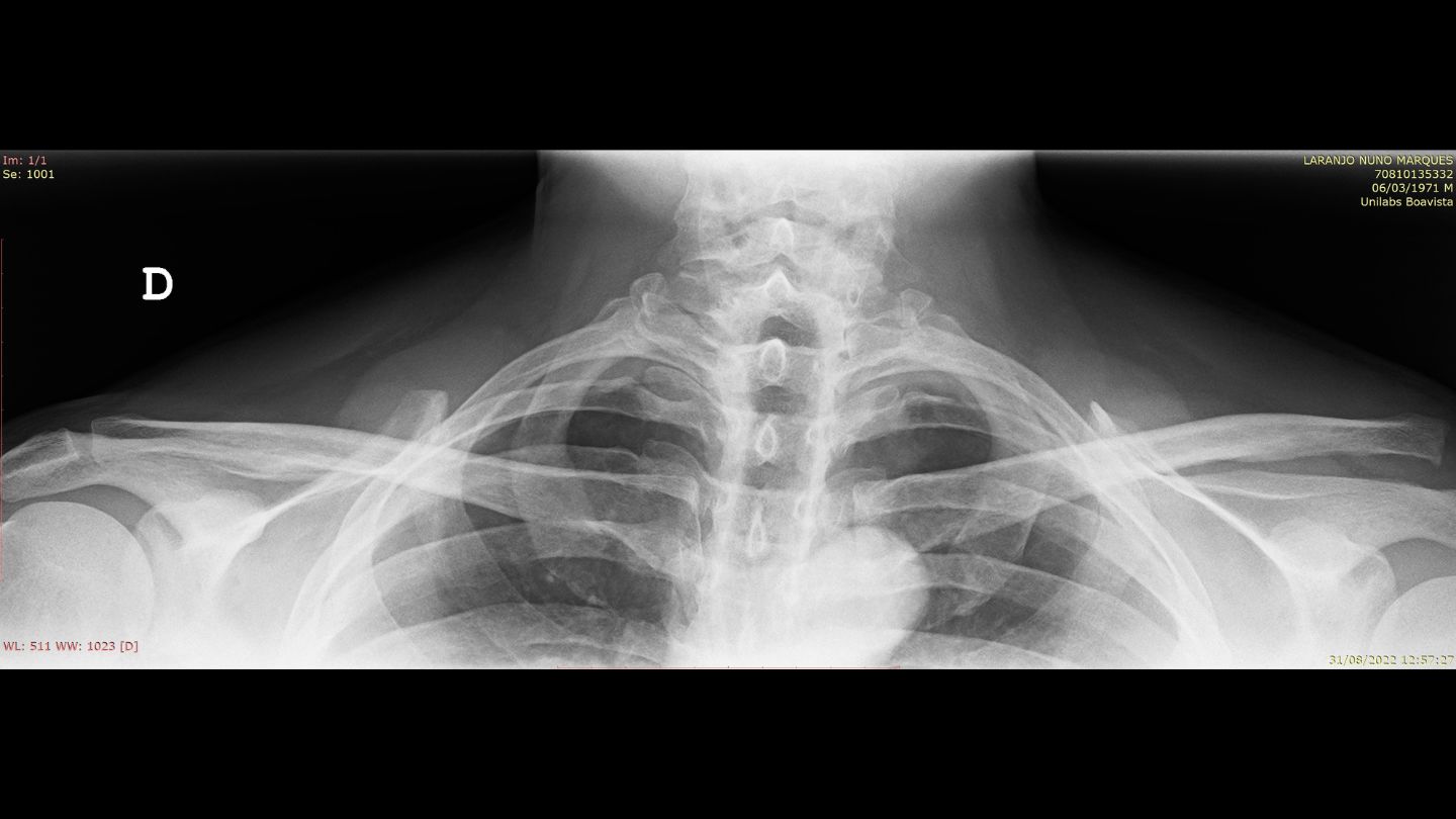 Tratamento de Luxação Acromioclavicular​ (3)