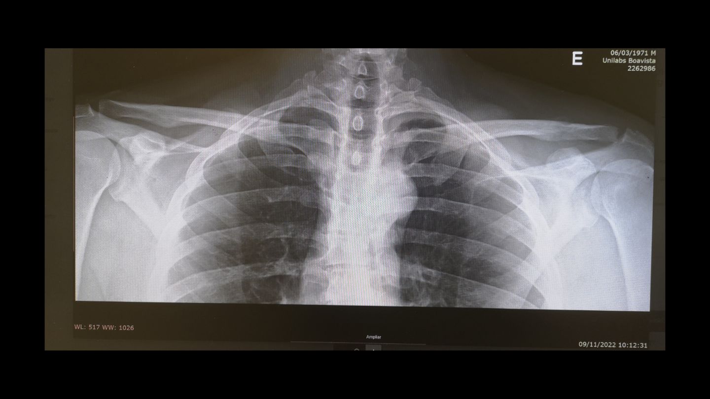 Tratamento de Luxação Acromioclavicular​ (4)