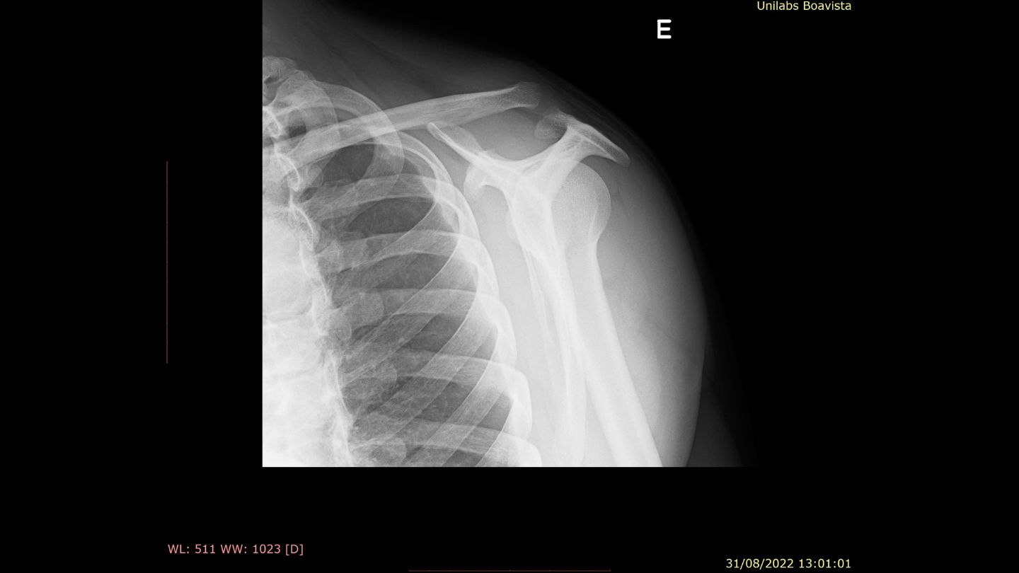 Tratamento de Luxação Acromioclavicular​ (7)